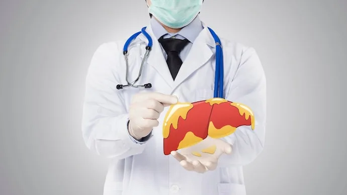 Medical illustration of a human liver showing fatty liver disease and fat accumulation within liver tissue.
